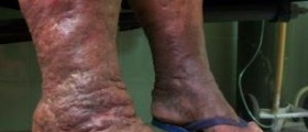 Therapy for lymphedema