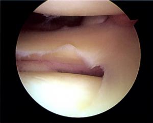 Therapy for meniscus tear
