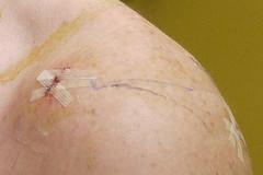 Therapy for pinched nerve in shoulder