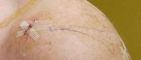 Therapy for pinched nerve in shoulder