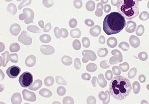 Therapy for polycythemia vera