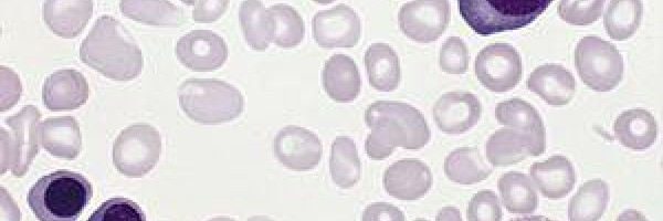 Therapy for polycythemia vera