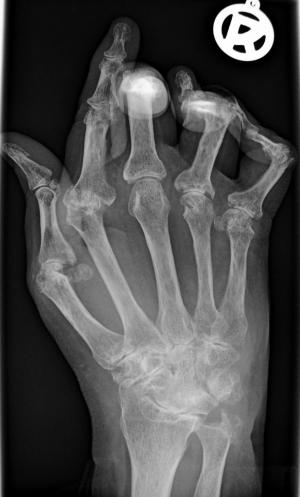 Therapy for rheumatoid arthritis