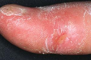 Therapy for systemic sclerosis