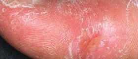 Therapy for systemic sclerosis