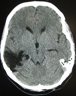 Therapy for traumatic brain injury