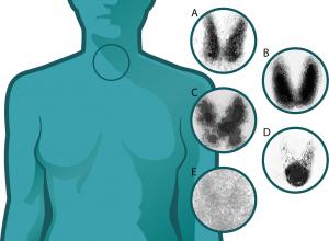 Thyroid cancer review