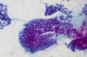 Thyroid cancer symptoms