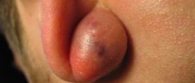 Tips for sebaceous cysts