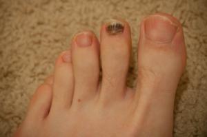 Toenail falling off - what to do