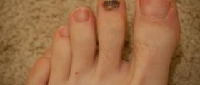 Toenail falling off - what to do