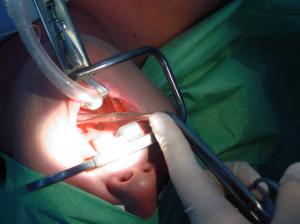 Tonsil stones treatment - how do you cure tonsil stones?