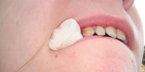 Tooth extraction: Would You Be Able To Recognize Infection And Other Complications?