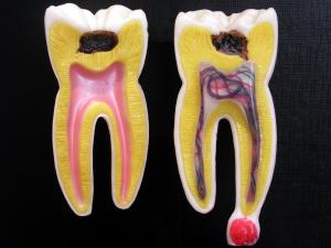 Tooth abscess review