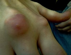 Tophi gout treatment will improve