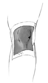 Torn cartilage facts