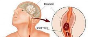Transient Ischemic Attack (TIA) - Warning sign of potential stroke!