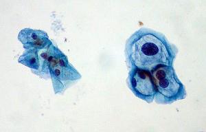 Transmission of high risk HPV