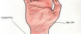 Treat carpal tunnel syndrome with acupuncture