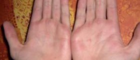 Treatment for blisters on hands