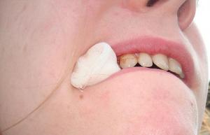 Treatment for dry socket after tooth extraction