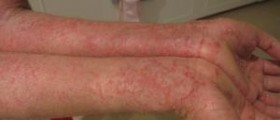 Treatment for eczema