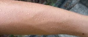 Treatment for excessive sweating