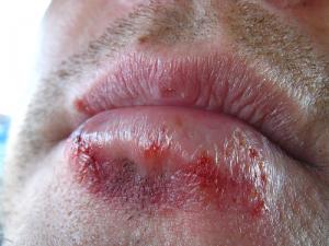 Treatment for oral herpes