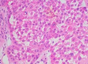 Treatment for squamous cell carcinoma