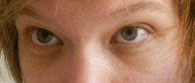 Treatment for under eye dark circles