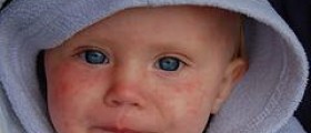 Treatment of viral infections in children