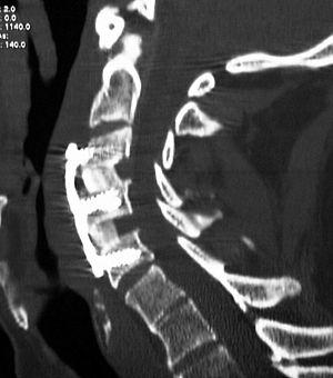 Treatments for spinal cord injuries