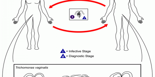 Trichomoniasis: Symptoms & Treatment