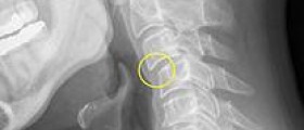 True neck traction - the right kind of neck traction for long term pain relief