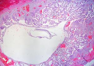 Tubal pregnancy symptoms