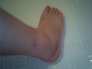 Twisted ankle facts