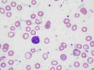 Types of anemia