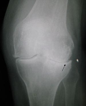 Types of arthritis that may affect the knee joint