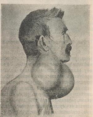 Types of thyroid cancer