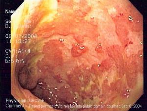 Ulcerative colitis symptoms and treatment