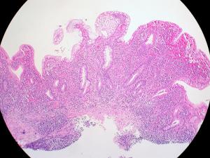 Ulcerative colitis treatment