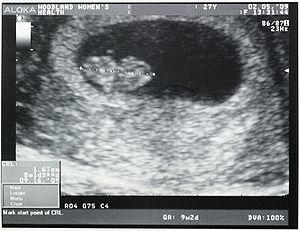 Ultrasound imaging for endometrial hyperplasia
