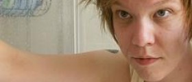 Under eye surgery for dark circles