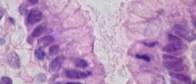 Understanding acute gastritis