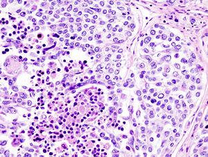 Uterine cancer classification and diagnosis