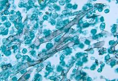Vaginal diseases: Vaginal bacterial infection