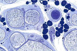 Vascular diseases: Arteries, veins and lymph vessels