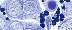 Vascular diseases: Arteries, veins and lymph vessels