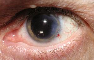 Vision impairment problems in elderly