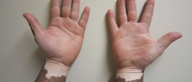 Vitiligo Gene May Protect Against Deadly Malignant Melanoma